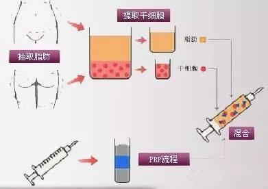 韩国江南三星沈秉宽院长来带你认识受求美者热捧的吸脂术