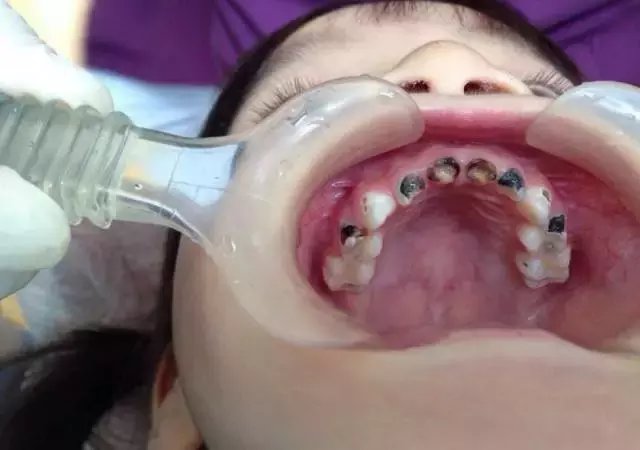 一岁小宝宝, 牙齿全坏了! 这个习惯你家有吗?