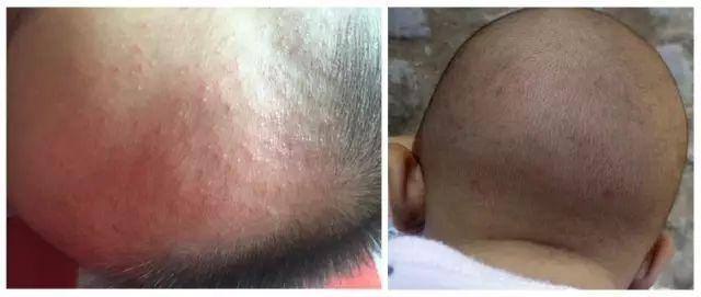 起红疹就是热痱? 3招教你预防宝宝长痱子!