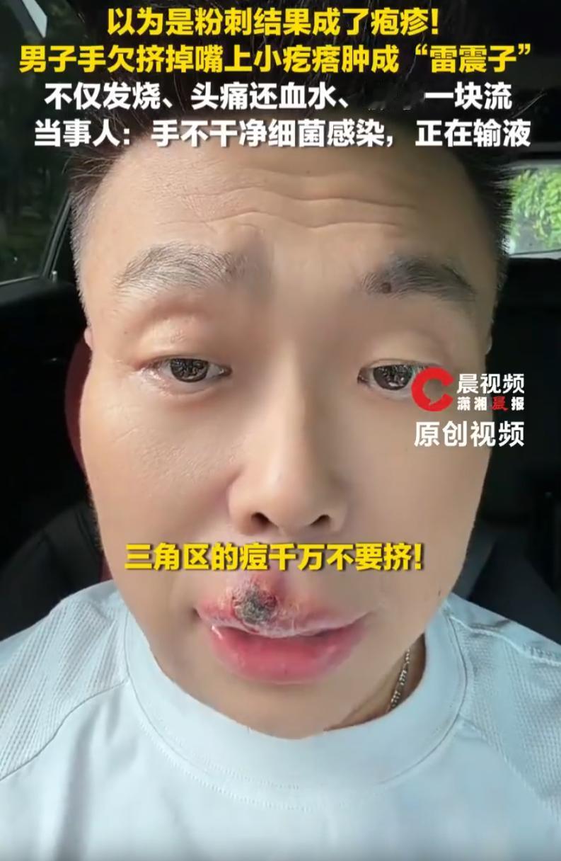 这下不敢手欠了！男子发现自己嘴唇上长了个小包，他以为是粉刺就随手一挤，不料晚上身