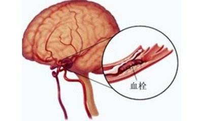 血栓的十大暗号, 你不能不知道!