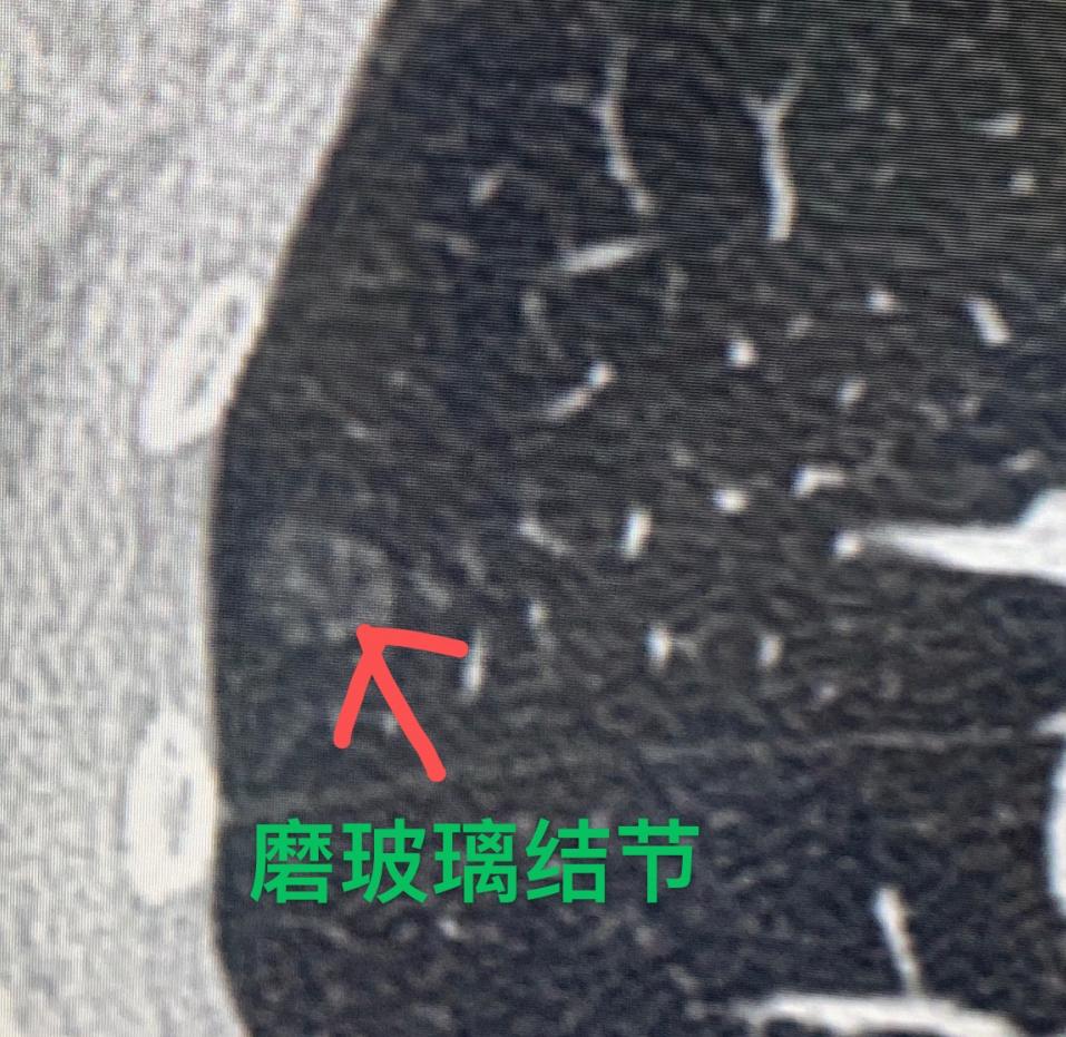 很多朋友来找我看病，我告诉他们：“你这个肺结节有问题，考虑是肿瘤，我们还是要及时