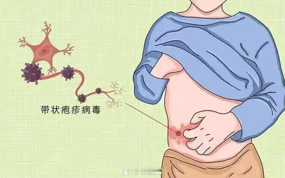 据研究显示，糖尿病患者患带状疱疹的风险比普通人更高，而且情况往往更糟糕。糖尿病患