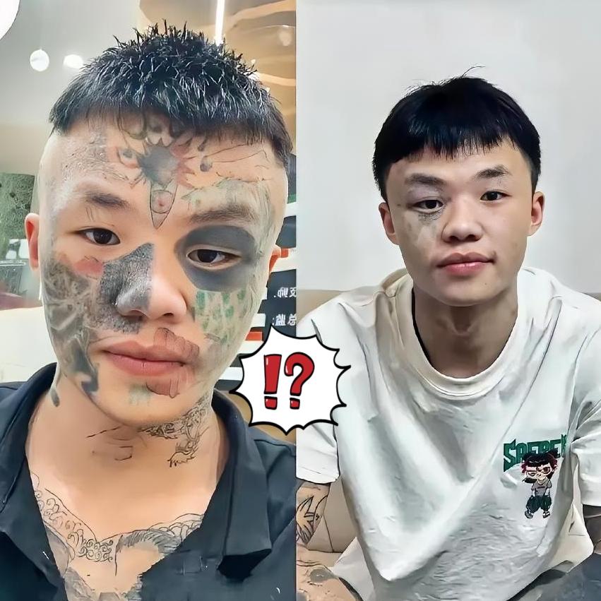 你敢信吗？广东有个男孩，现在19岁，正一趟趟跑医院，拿激光往自己脸上打。疼得直抽