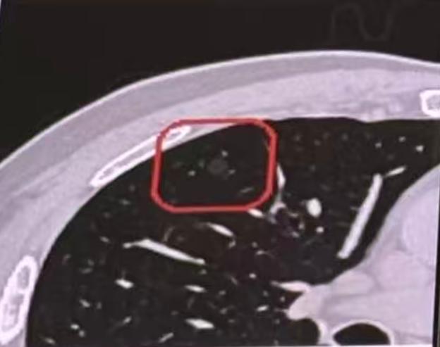 肺结节确实发现得越来越多了，很多朋友在发现肺结节后，会感到特别紧张，但我认为，大