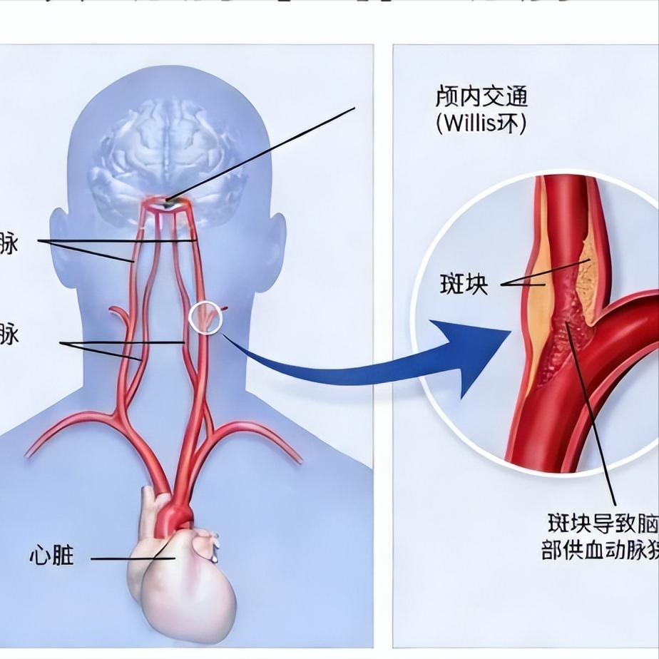 脑出血后别只盯着腿！手废了才是真麻烦，这3个动作赶紧练1.夹纸巾在桌上平铺