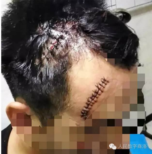 商洛男子路上居然被天上掉下的"飞机"砸破头