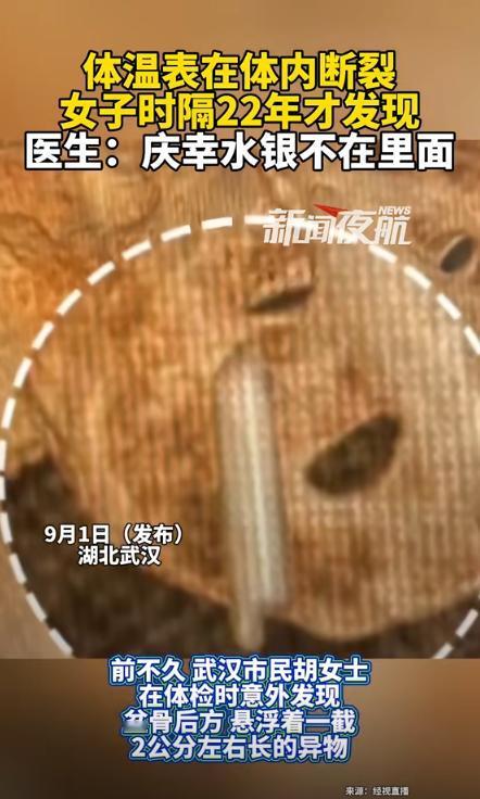 “彻底解释不清了！”湖北武汉，一女子参加体检时，意外发现盆骨里有奇怪异物，足足有