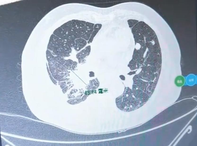 说到肺癌的基因检测，相信很多朋友都纠结过：做吧，得自己掏钱，常常要花几千甚至两三
