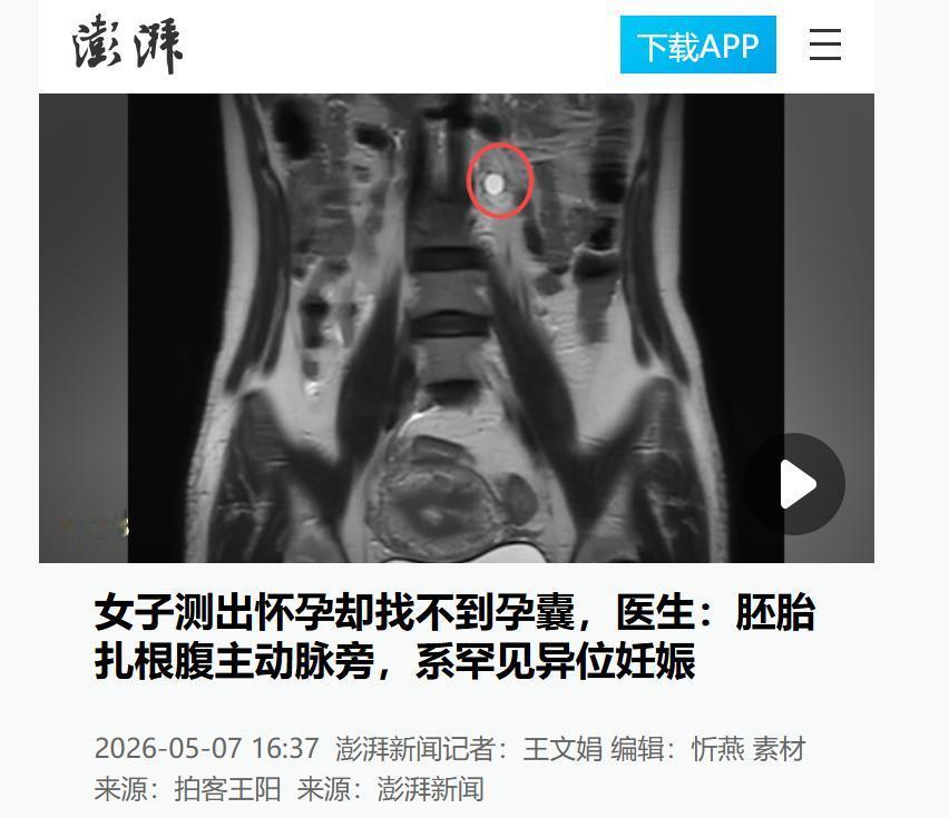 太惊险！广东深圳一女子验孕棒查出怀孕，抽血也确认妊娠，可B超始终找不到孕囊，