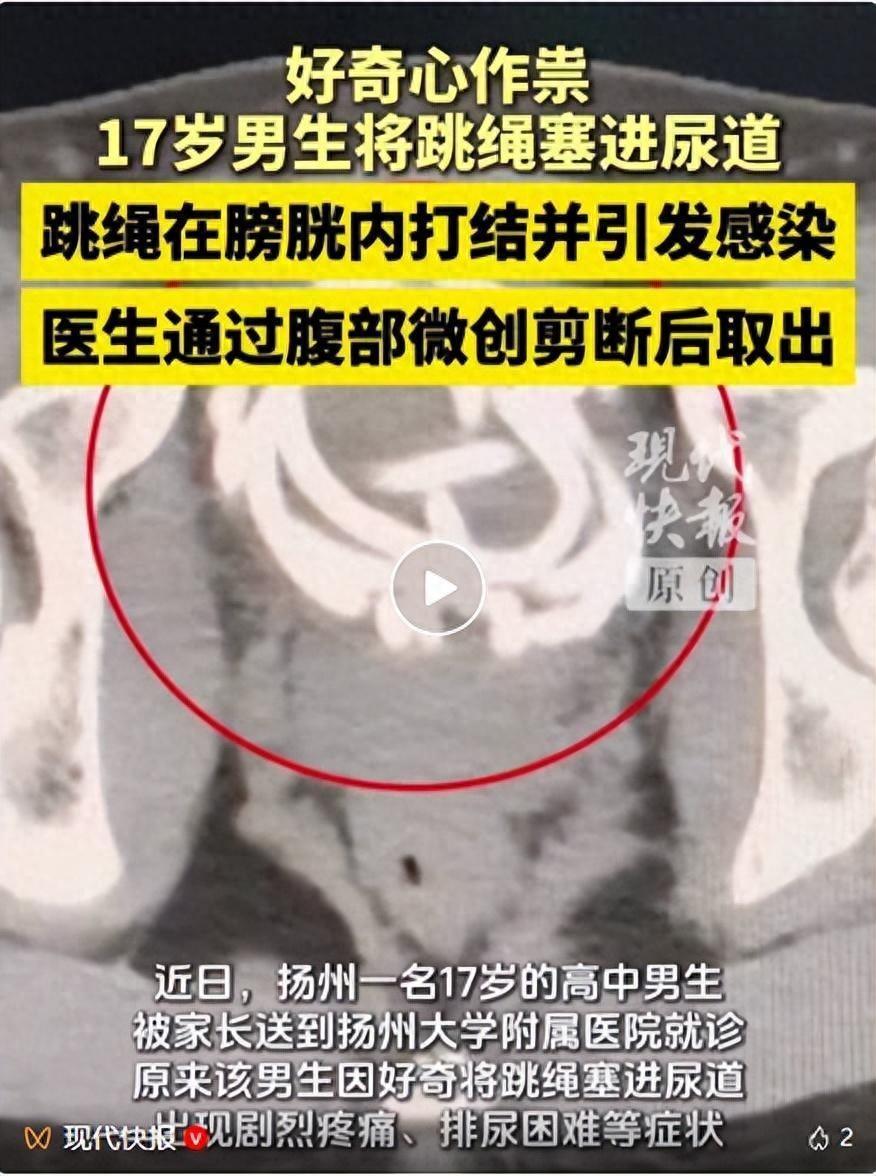 “离了个大谱！”近日，江苏扬州，一17岁高中男生因为好奇，竟将橡胶跳绳插入尿道，