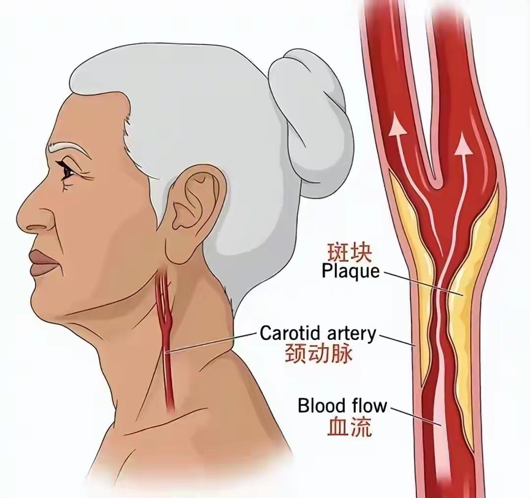 颈动脉斑块，脑梗的“定时炸弹”？医生：做好3件事，轻松拆除！——但请先认清：真