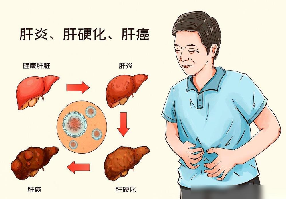 就前几天，一个活生生的人，肝癌晚期。​查出来之前，他还跟所有人说，乙肝不用治