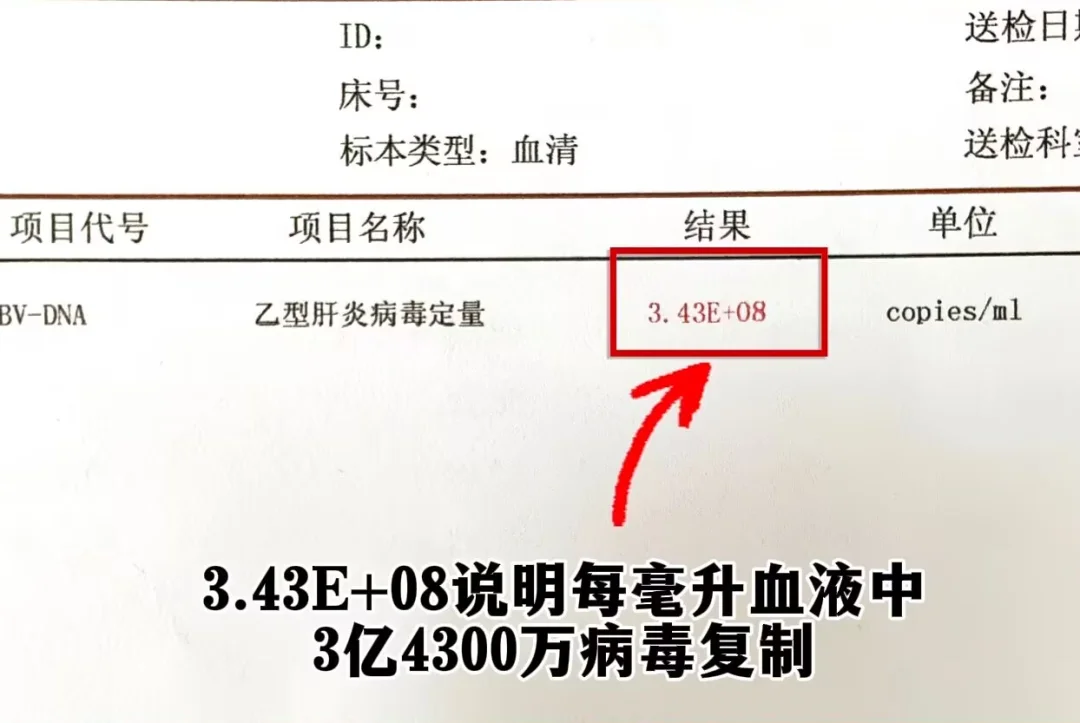 乙肝病毒量8次方 上亿病毒需要治疗吗？ 这是上午接诊的一位乙肝小伙，病...
