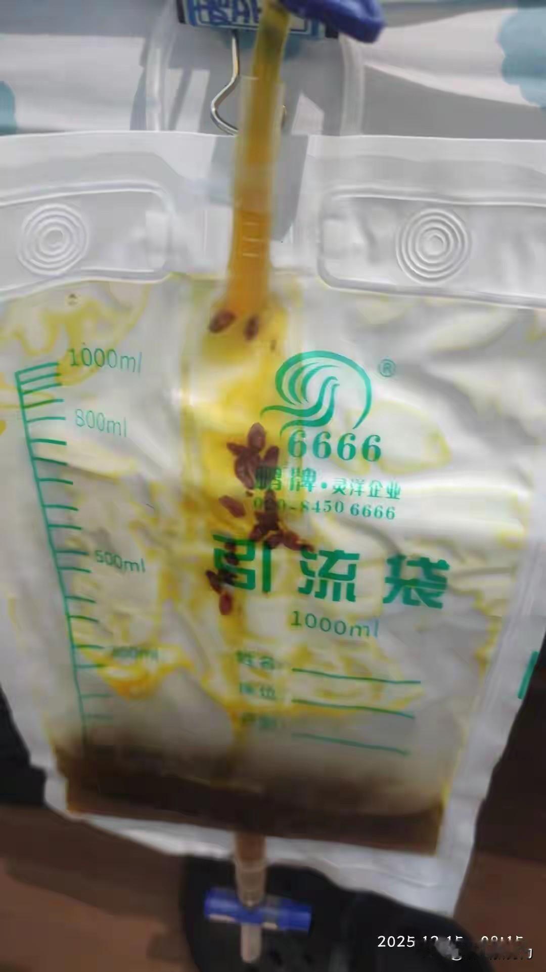 吃淡水鱼生可得小心了！广东40多岁的厨师刘先生，近期右上腹隐痛、消化不良，以为是