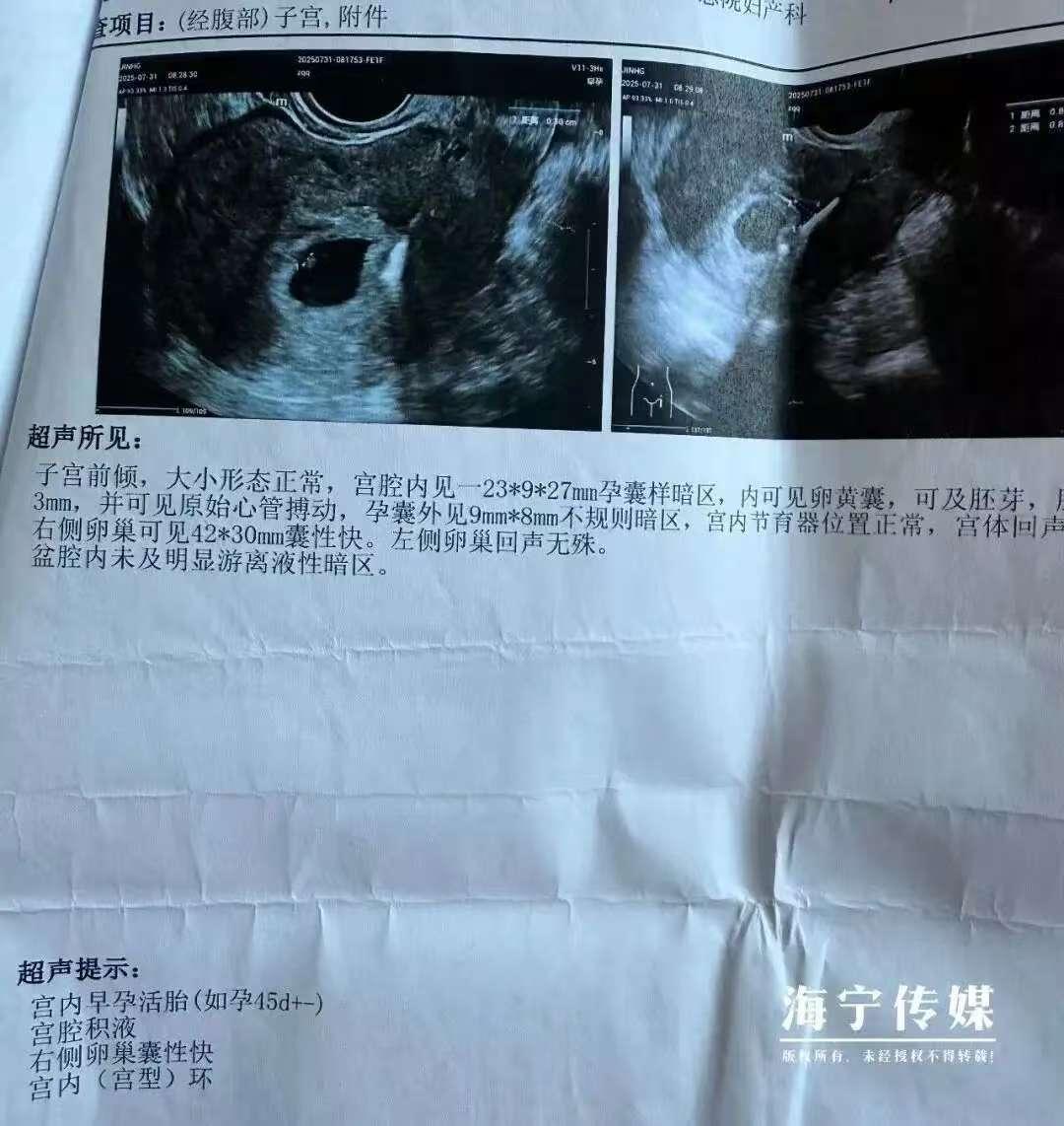 “这就是命！”浙江海宁，一35岁女子生儿子剖腹产时，她就上了避孕环，可8年后，她