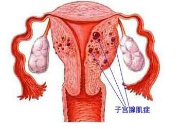 得了子宫腺肌症, 能怀孕吗? 北京协和专家告诉你