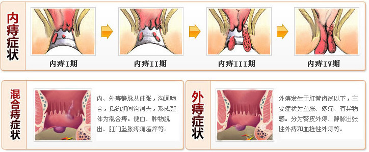柳州东大肠医院痔疮的症状