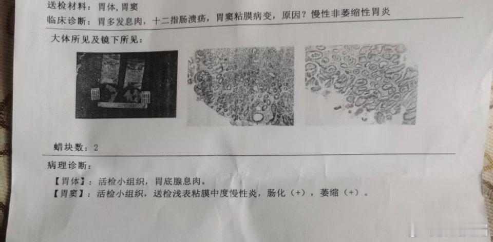 胃黏膜肠化是胃黏膜上皮细胞被肠型上皮细胞取代的一种病理改变，属于胃癌前病变，但并