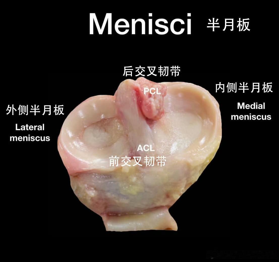 盘状半月板前几天发了半月板手术的科普，有朋友提到盘状半月板怎么办？今天来详细讲