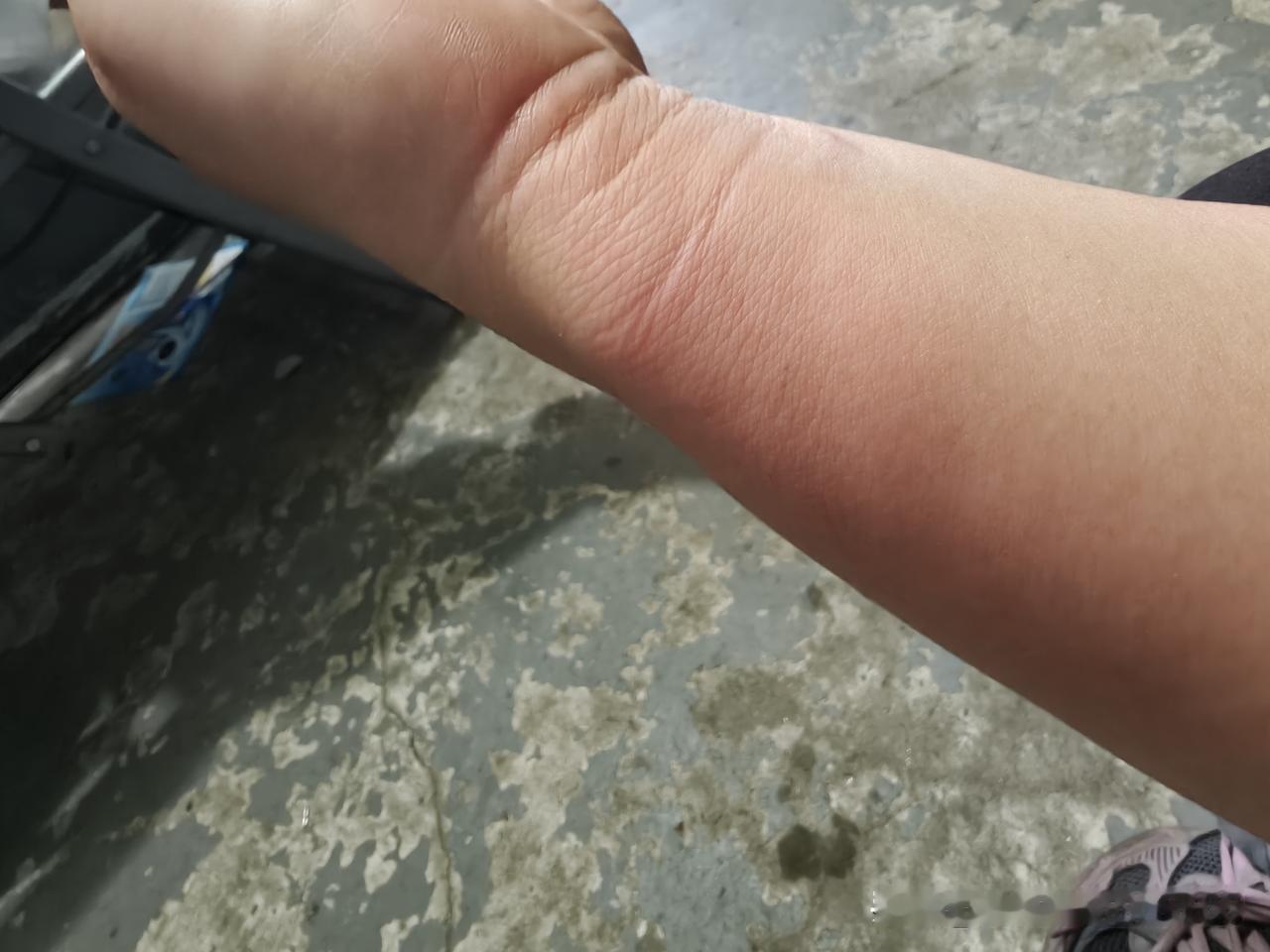 今天干活不小心把手烫得通红，火辣辣的疼，钻心难受。凉水冲了好一会儿才稍微缓解