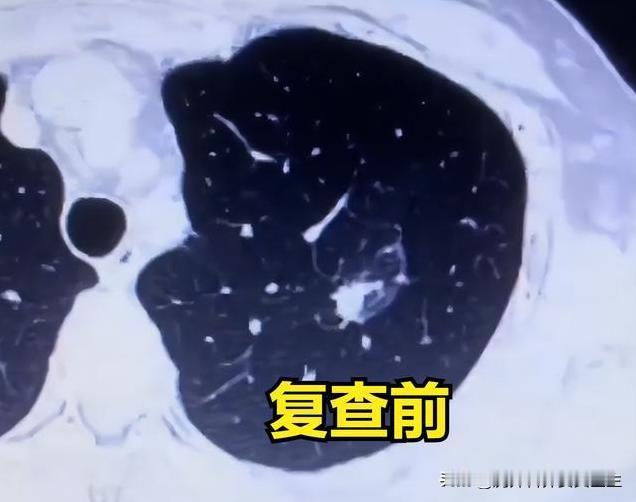 肺混合磨玻璃结节别急着手术，符合这3种情况很有可能消失！根据多年看片子的经验，确