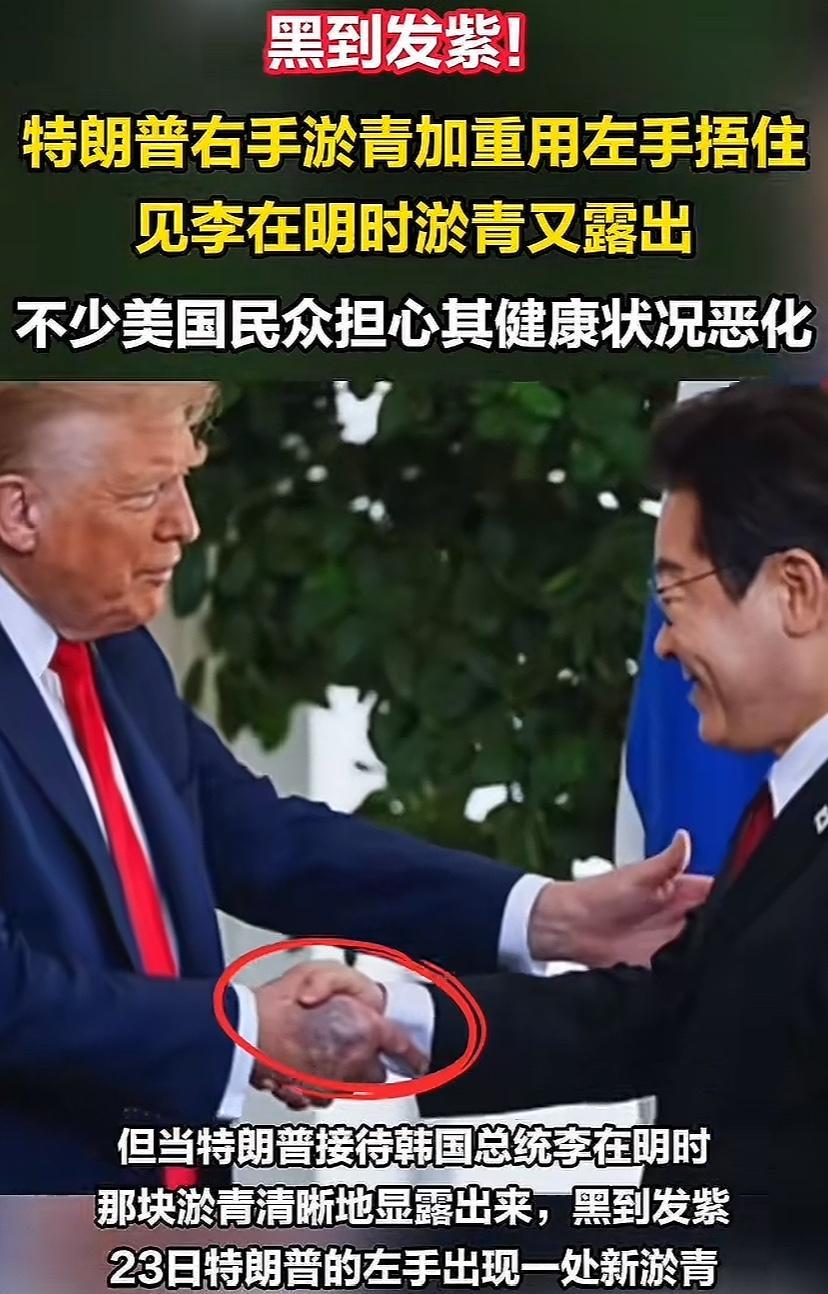 川普这只手着实有点吓人，看脸色挺正常，手上怎么会出现黑紫一大片，感觉不是握手影响