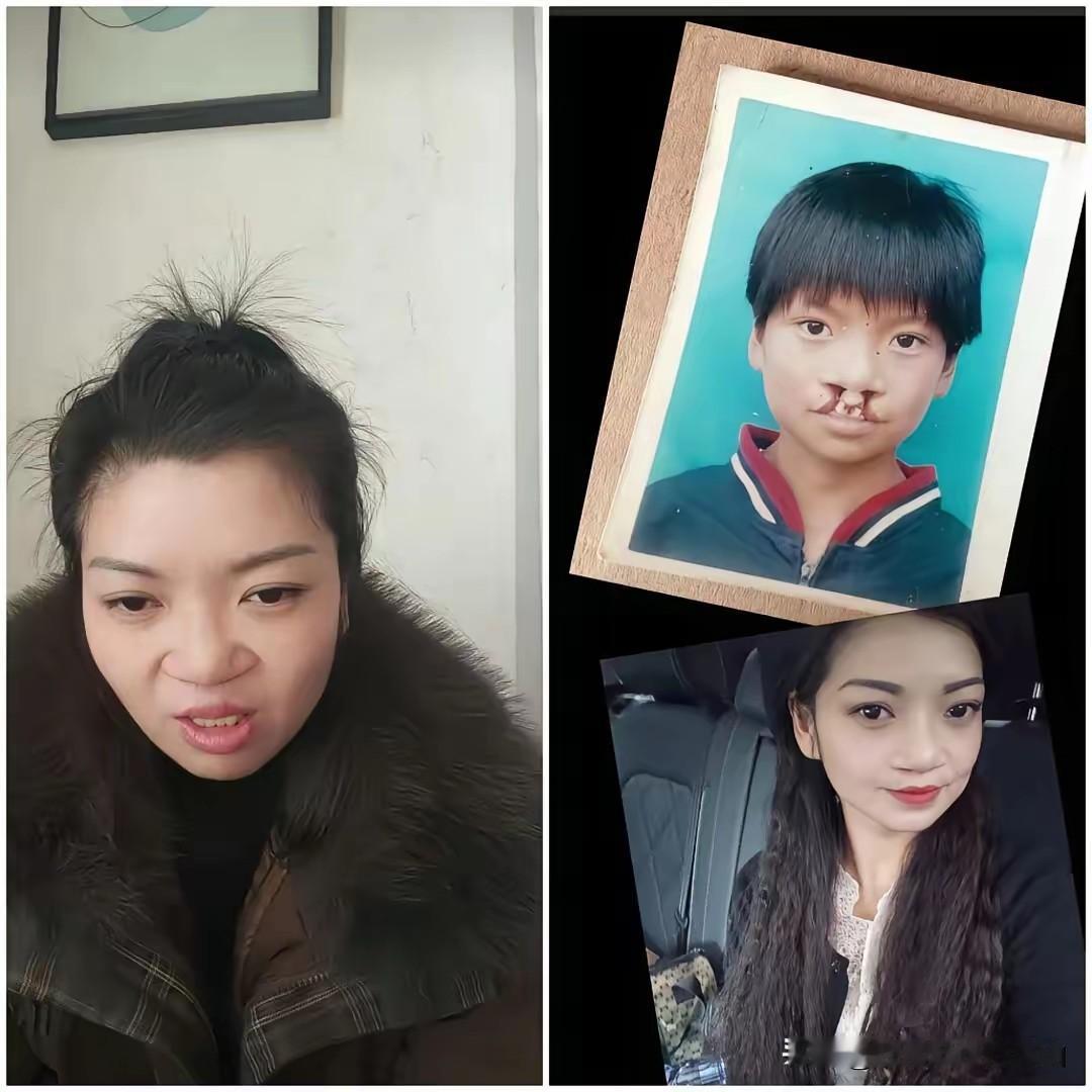 终于有患者站出来为嫣然基金会说话了，还和李亚鹏连线，能和李亚鹏连线她很激动，不断