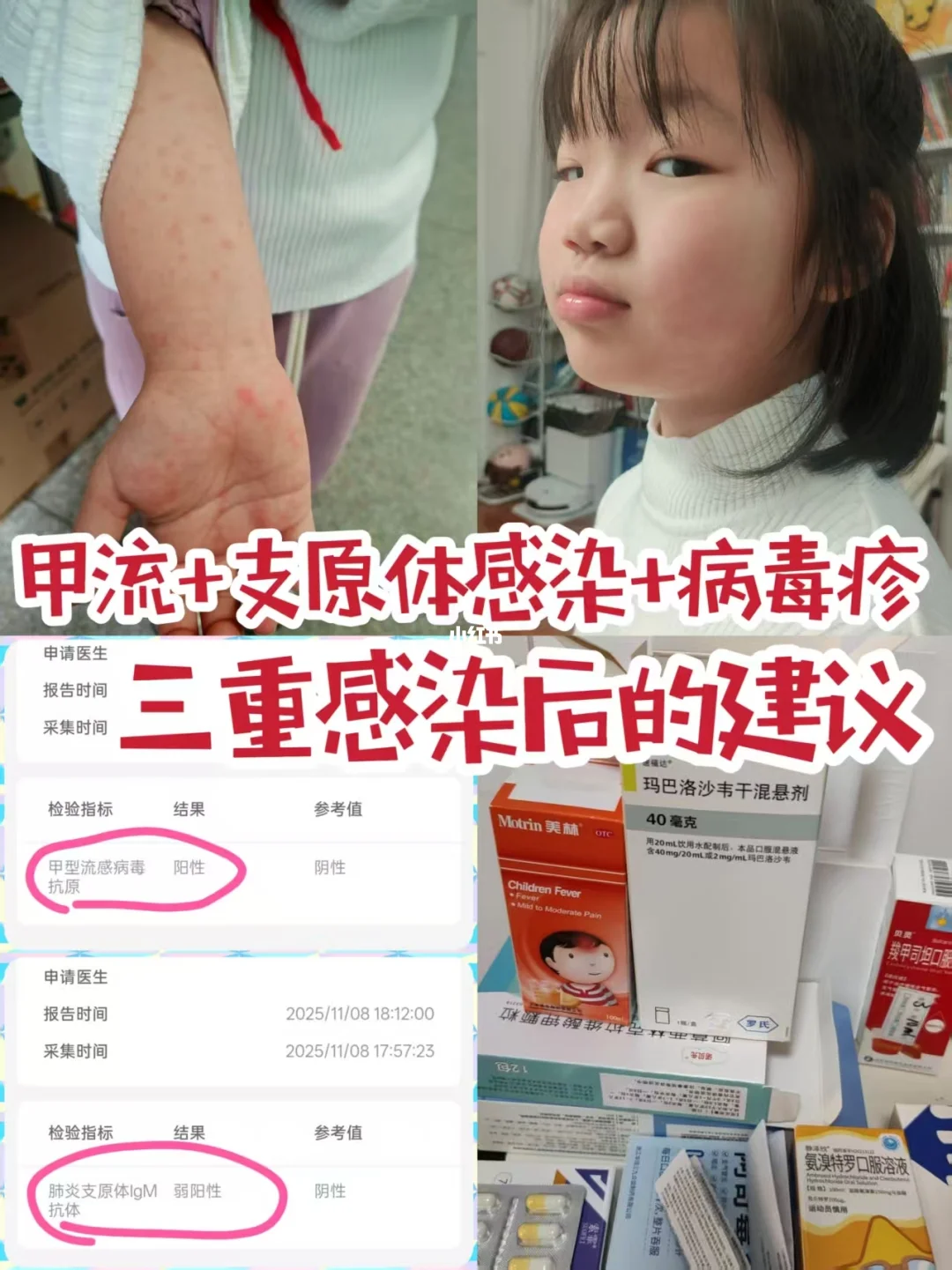 甲流+支原体感染+病毒疹，三重感染后的建议