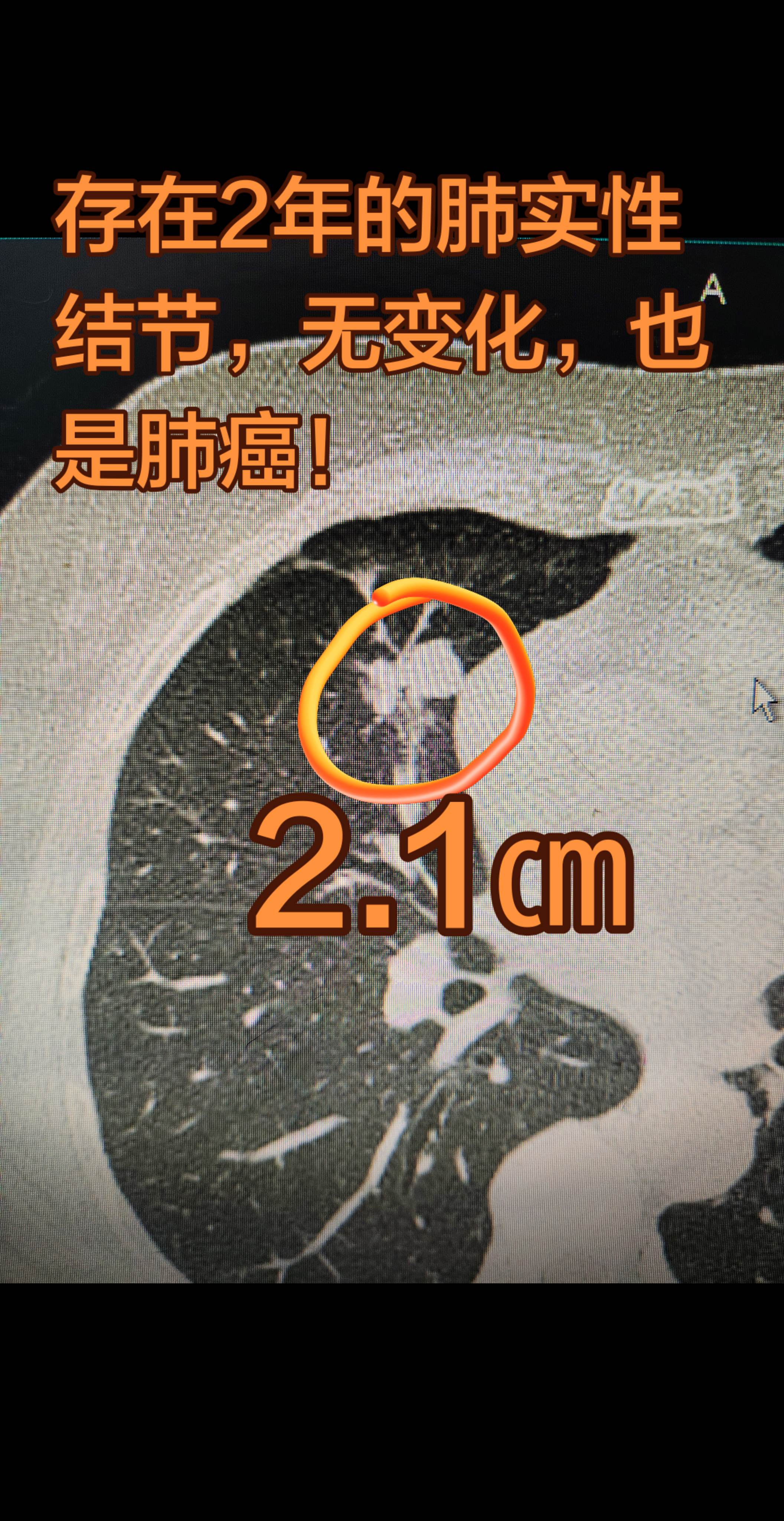 肺结节与肺癌。两年前检查发现的肺实性结节，PET-CT不考虑恶性，这次...