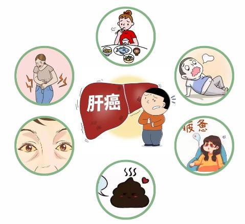 肝癌的6大症状表现！肝癌早期症状隐匿，很多人发现时已到中晚期。日常出现以下6