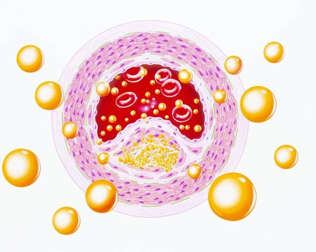 隔天吃一次他汀，降脂效果更好吗？医生忠告：服用他汀，牢记4点对于高胆固醇患者