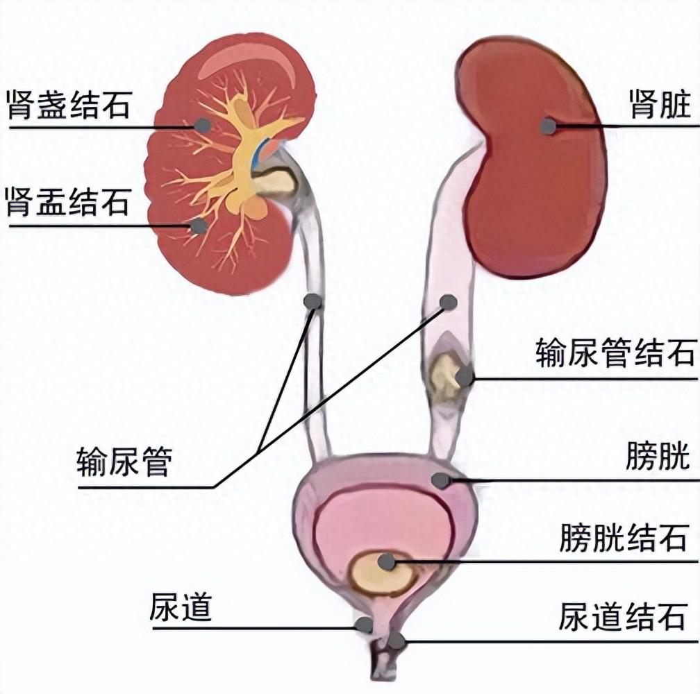 结石堵肾、膀胱、输尿管、尿道？1药堪称「碎石推土机」，4类结石全铲除！大家