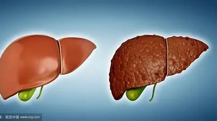 肝硬化就是这么控制的，以后别再盲目治疗了！2025年第一个好消息和病毒性、