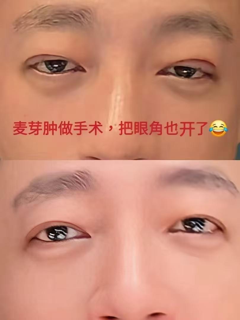 汪小菲澄清了不是故意去做双眼皮的。随老汪，年龄大了眼皮就又肿又抬不起来，还是单眼