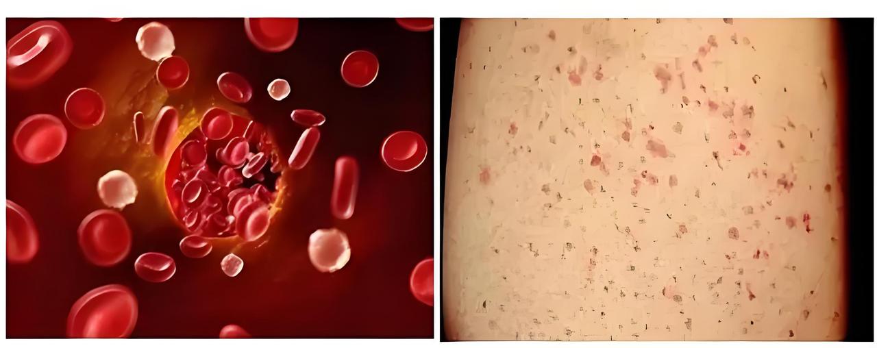 血小板减少止血方法血小板减少时，止血的方法主要有以下几种：1.药物治疗：