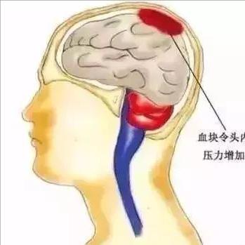 脑出血最爱找上这5类人，看看你在不在其中！1️⃣血压高还不当回事的血压长期