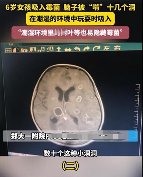 1月15日河南一名6岁女童，发烧烧了整整17天，一开始可能以为是普通感冒，没料到