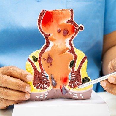 痔疮手术痛到自杀？三甲医生说清真相，24小时疼痛高峰这样应对这消息看得人后