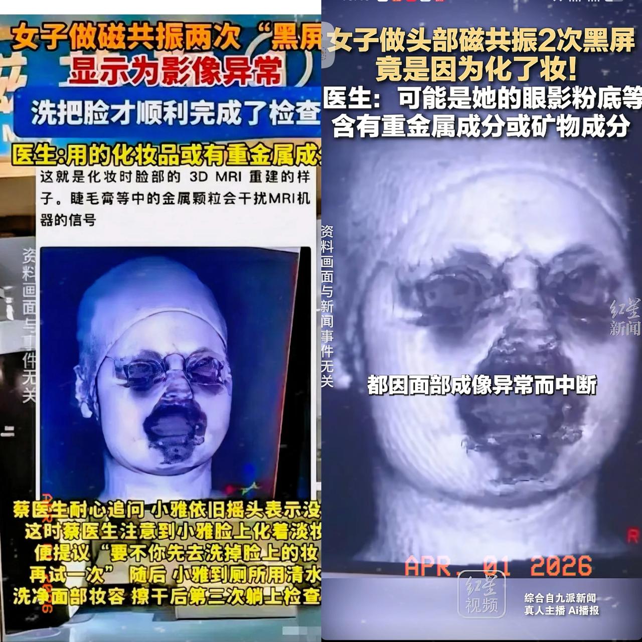 真是解释不清了！福建一位29岁的女生因为头晕，去医院做头颅核磁共振。没想到连续