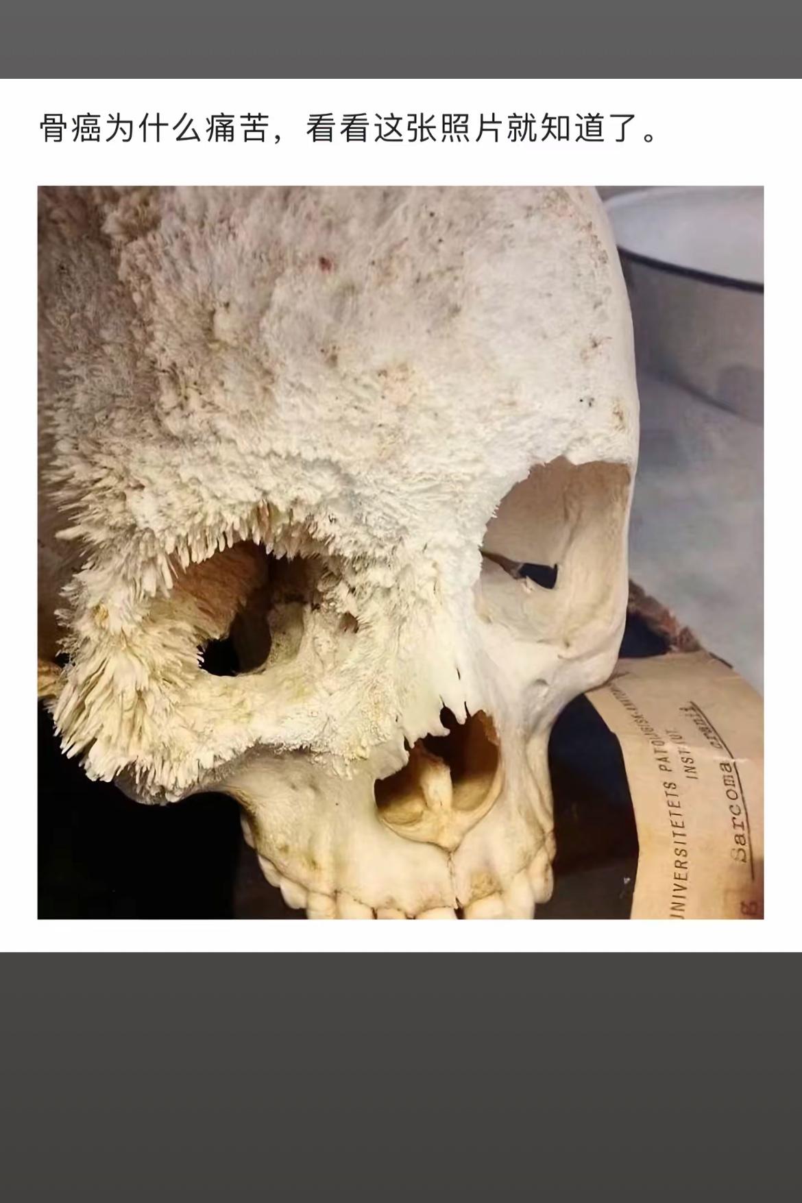 骨癌的痛苦，看这张照片就知道。