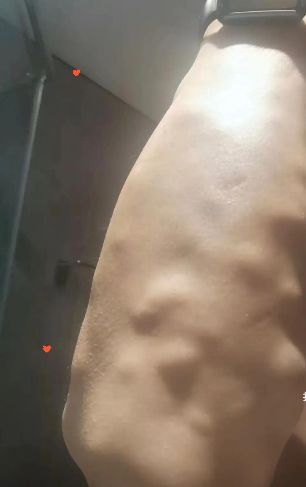 医学这么发达难道连脂肪瘤都治疗不了？真不可思议。脂肪瘤就这么难治疗吗，网络上基本