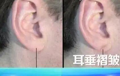 血管堵不堵 看脸和腿就知道? 6个信号别忽视