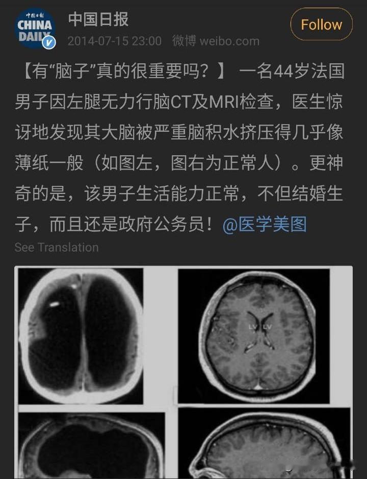 原来“脑子不太好使”真的可以字面理解。这位法国大哥的大脑被积水压成了薄纸，却照样