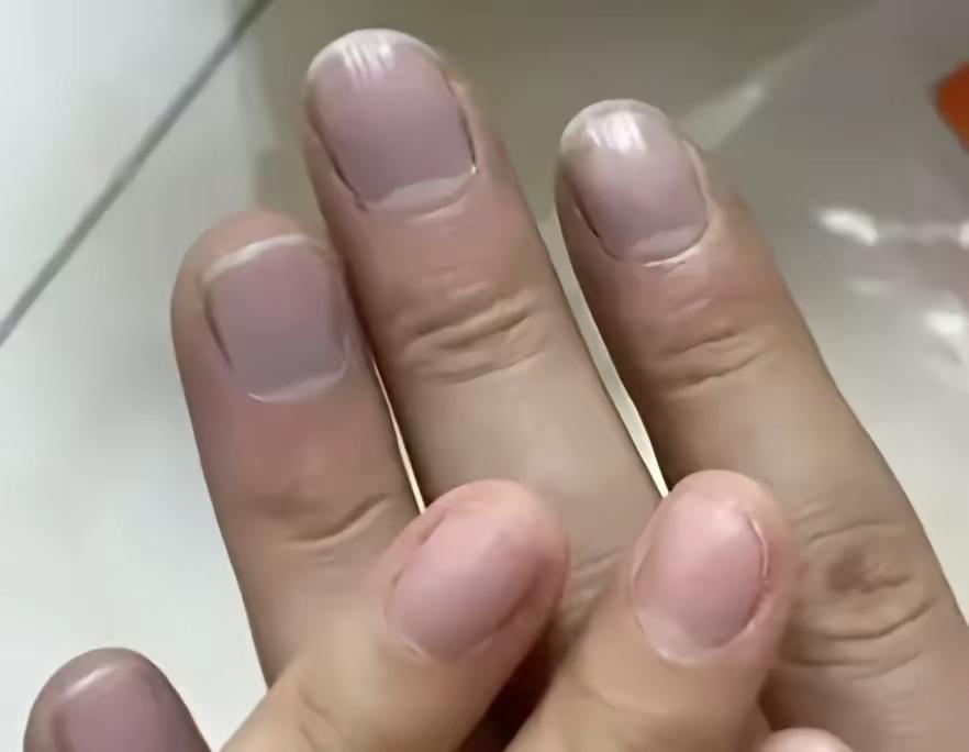 “太固执了！”近日，一女子发现老公手指甲发紫，怀疑心脏有问题，劝他去医院检查，但