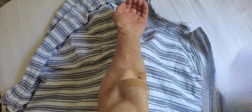 今天上午透析，一个老护士给我穿刺的，感觉还不错，暗地里高兴美滋滋。可是