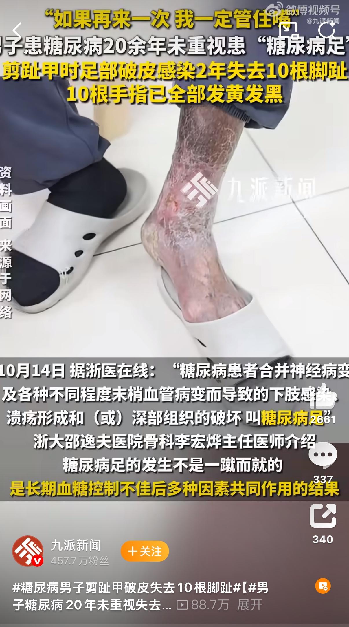 就因为剪指甲时不小心剪破点皮，两年不到竟把十根脚趾全截了？浙江那位陈大叔，得糖尿