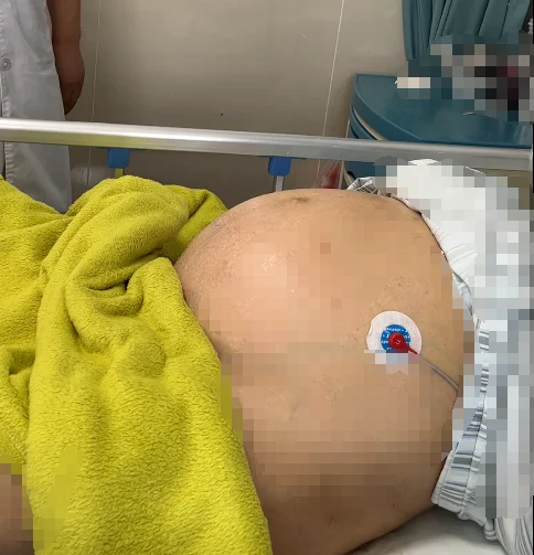 像这样的大肚子肝腹水，现在也有办法对付了