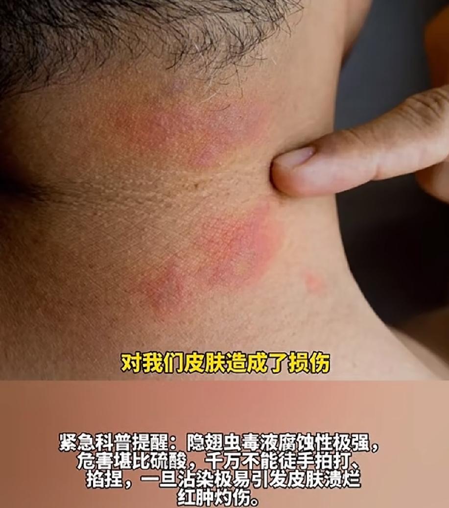 9月15日，陕西。几只黑红相间、色泽艳丽的虫子落在了女子的手上，既不叮人，也不咬