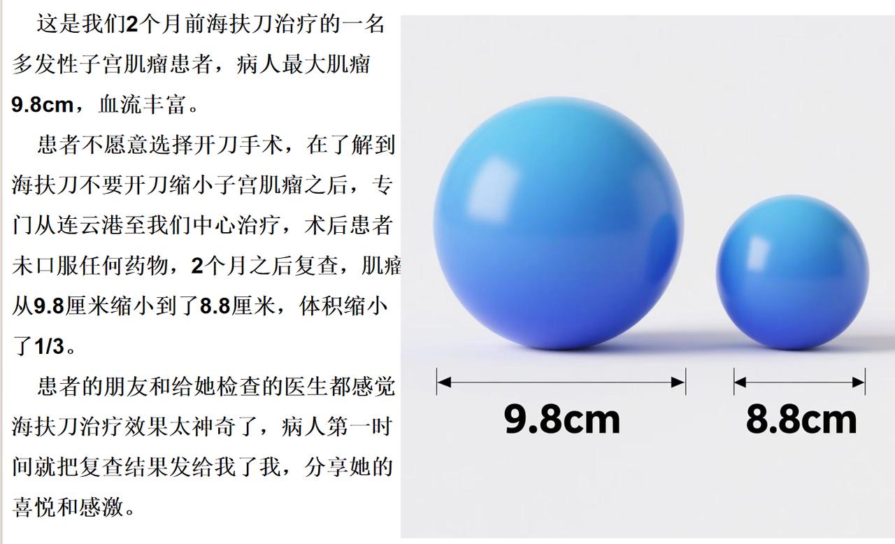 这是我们2个月前海扶刀治疗的一名多发性子宫肌瘤患者，病人最大肌瘤9.8cm，血流
